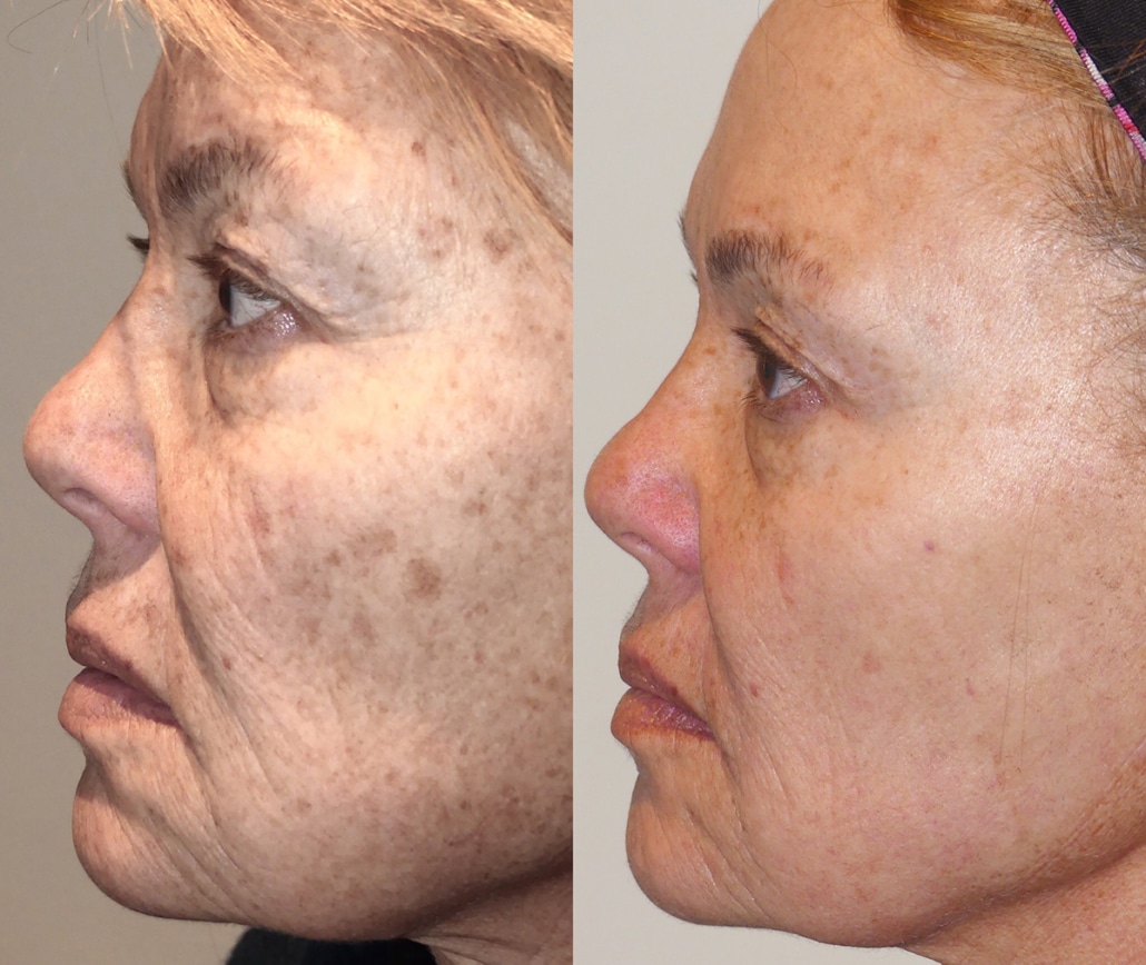 ipl-photofacial-1030x868-1.jpg